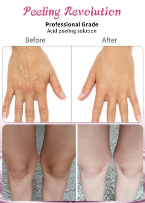 Profesyonel Kalite Asit Peeling Solüsyonu Yüz Peeling için Sıvı Set