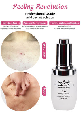 Peeling Serumu Deri Peeling Solüsyonu Akne Çıkartıcı Deri Bakımı Deri Peeling 30ml