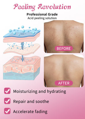 Peeling Serumu Deri Peeling Solüsyonu Akne Çıkartıcı Deri Bakımı Deri Peeling 30ml