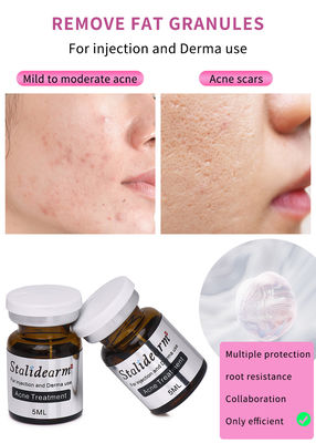 Stalidearm Dermal Fillers Akne Tedavisi Akne İyileşmesi ve Lekeler Azaltması için Enjeksiyon Serumu