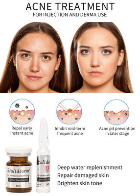 Stalidearm Akne Tedavisi Enjeksiyon Serum Mezoterapi Besleyici Yan Etki Yok